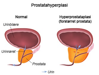 Hvad er BPH?