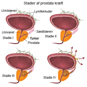 Få et overblik over prostatakræft symptomer