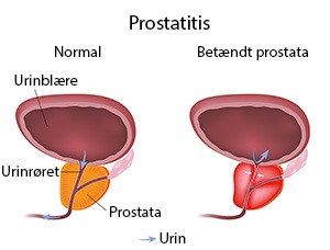 Hvad er prostatitis?