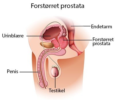 Forstørret prostata