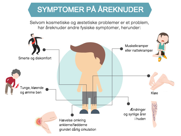 Symptomer på åreknuder?