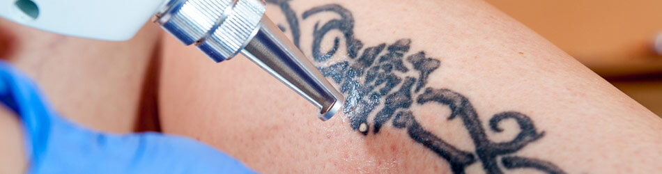 Laserfjernelse af en tatovering er et godt alternativ. Men det er ofte smertefuldt og meget dyrt.