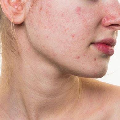Voksen hormonknopper Bedste acne
