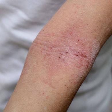 Hudinfektioner og hudsygdomme - Sådan behandles de