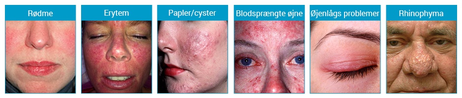 rosacea-shydk_banner