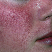 Inflammatorisk Rosacea