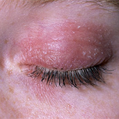 Okulær Rosacea 