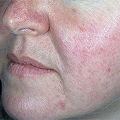 Phymatous Rosacea