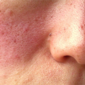 Vaskulær Rosacea