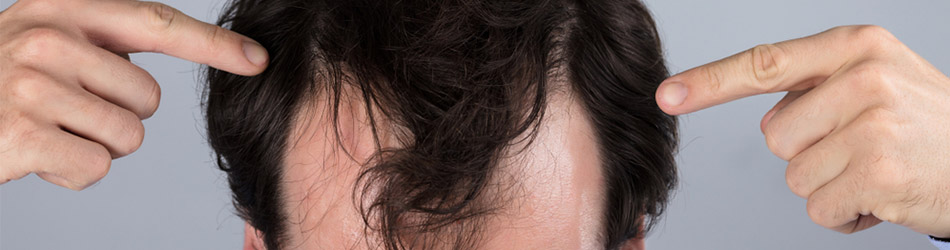 Høje tindinger er en af de første symptomer på hårtab hos mænd.