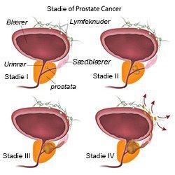 Prostatakræft Prostatakræft
