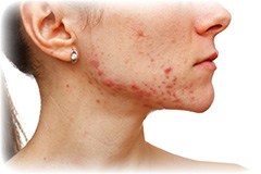 Hvad er et acne ar? Hvad er et acne ar?