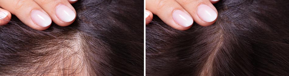 Pludseligt hårtab er normalt, men du kan heldigvis få hjælp til en sund og normal hårvækst med de rette hjælpemidler.