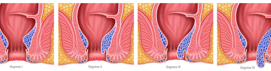 Hæmorider defineres baseret på fire forskellige stadier