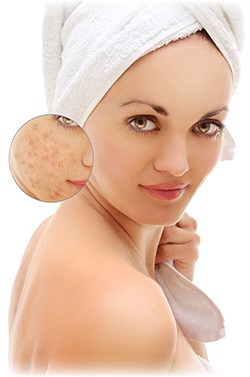 Fjern ar efter bumser og acne Fjern ar efter bumser og acne