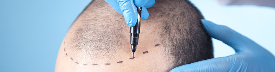 Transplantation af nyt hår er en permanent behandling af hårtab hos mænd.