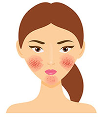 Rosacea